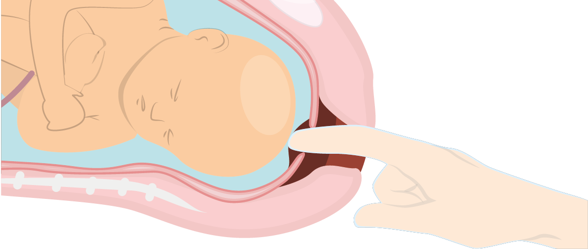 Décollement des membranes : controverse et risques - Bébés et Mamans